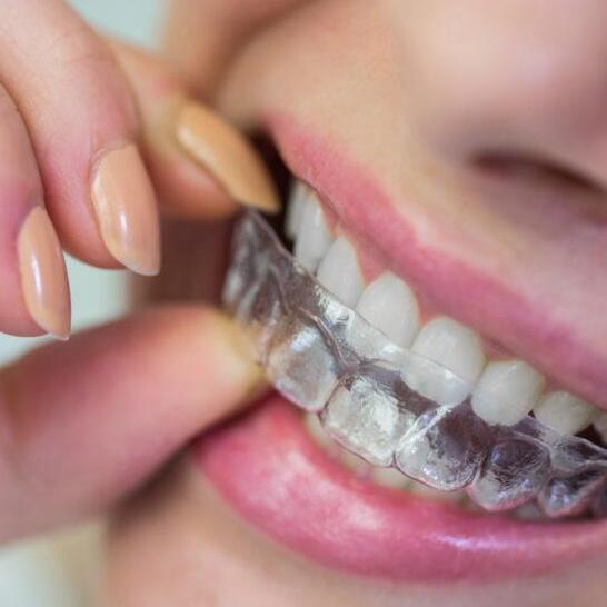 Invisalign Cost  Singapore