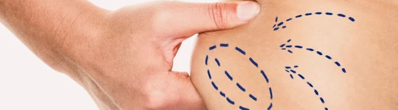Liposuction Surgery